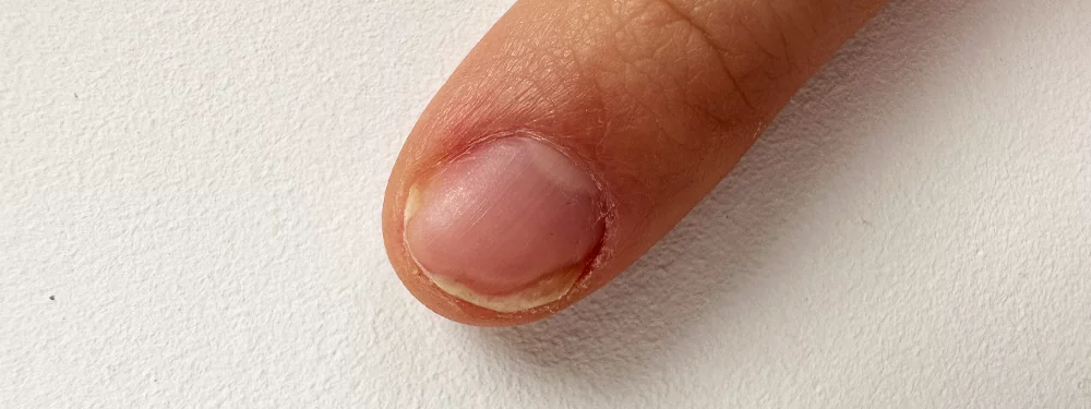 co-to-jest-onycholiza-w-stylizacji-paznokci